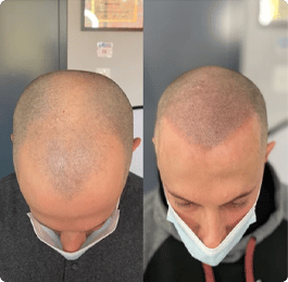 white man before and after scalp micropigmentation treatment at Edge Scalp Ink in Bethesda Maryland