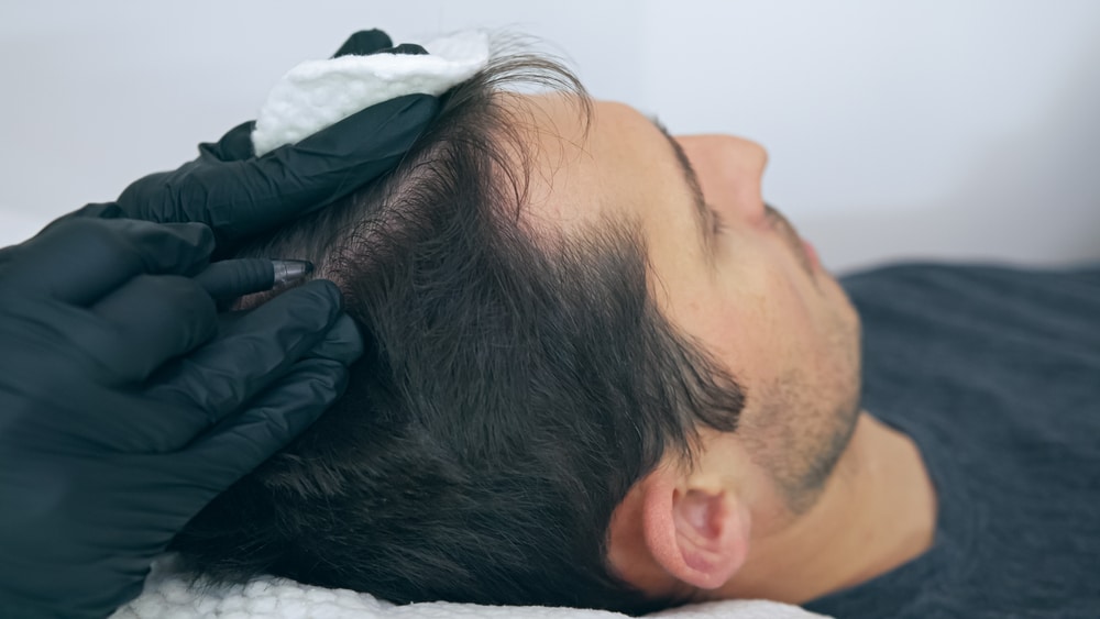 Man being prepped for scalp micropigmentation treatmentBlog Edge Scalp Ink in Bethesda Maryland