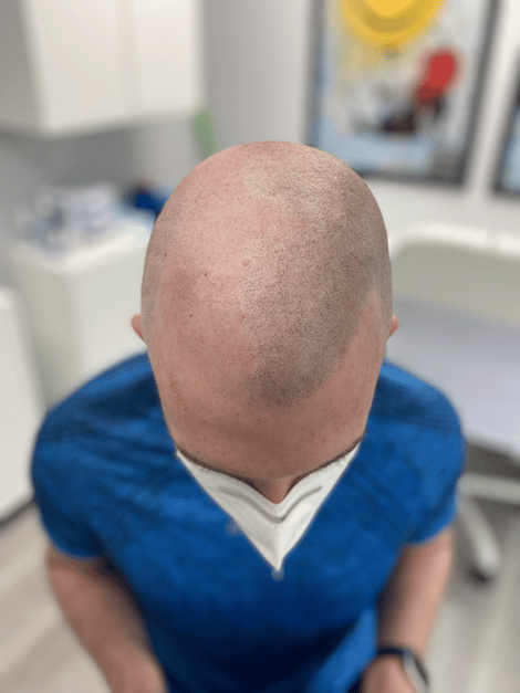 Midway through white /Caucasian male's scalp micropigmentaion treatment