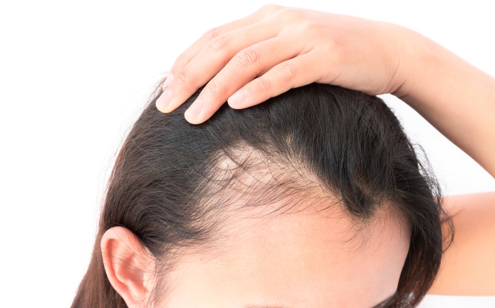 Women thinning hair scalp micropigmentation treatment