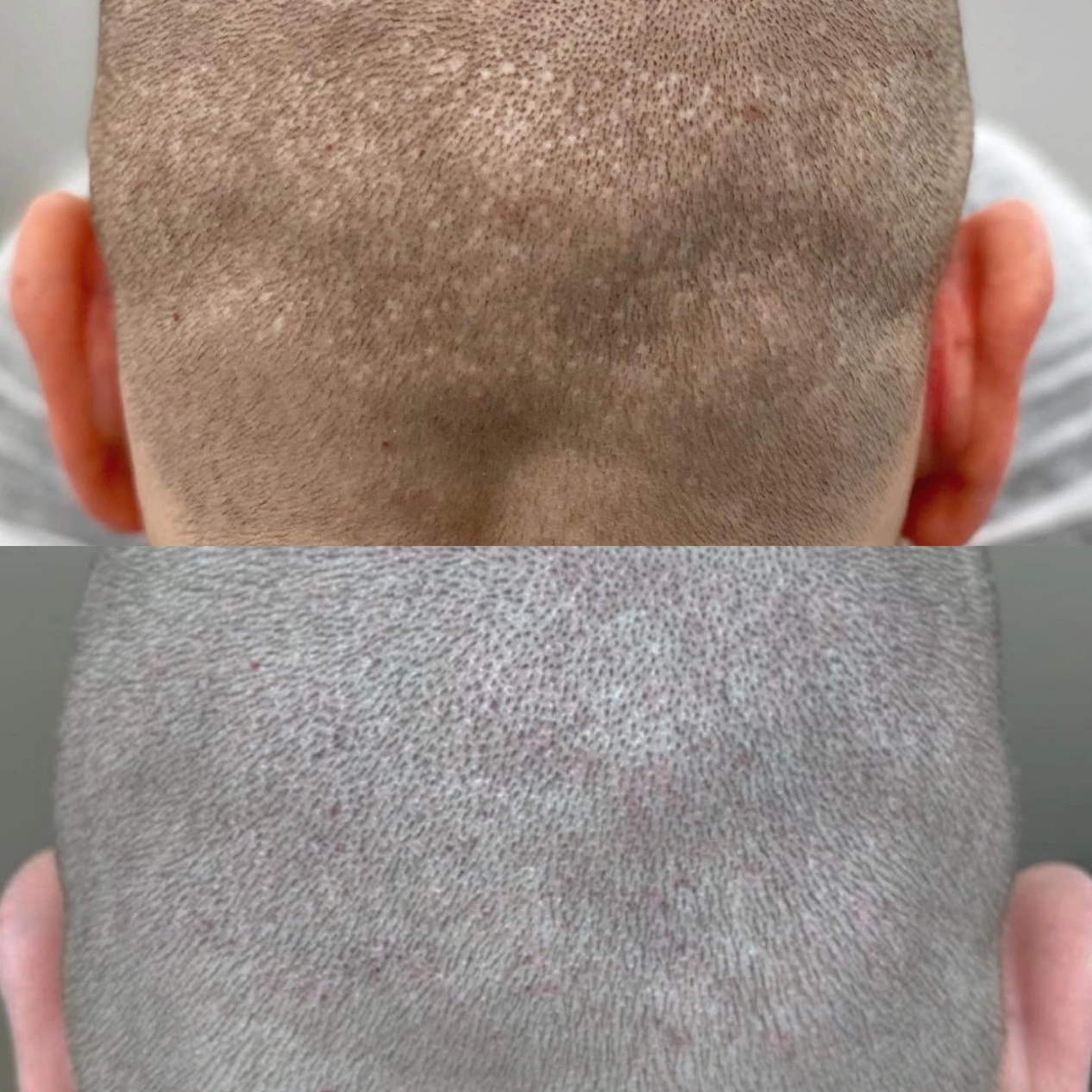 before and after scar camouflage scalp micropigmentation treatment