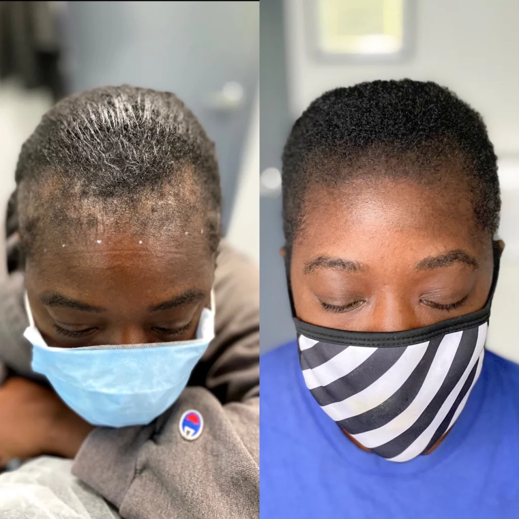 Ultimate Guide to Scalp Micropigmentation for Women & Men