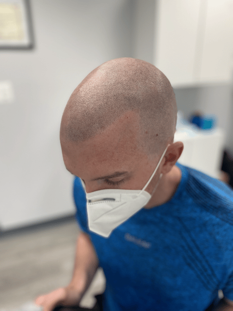 before photos of men's scalp micropigmentation for full scalp
