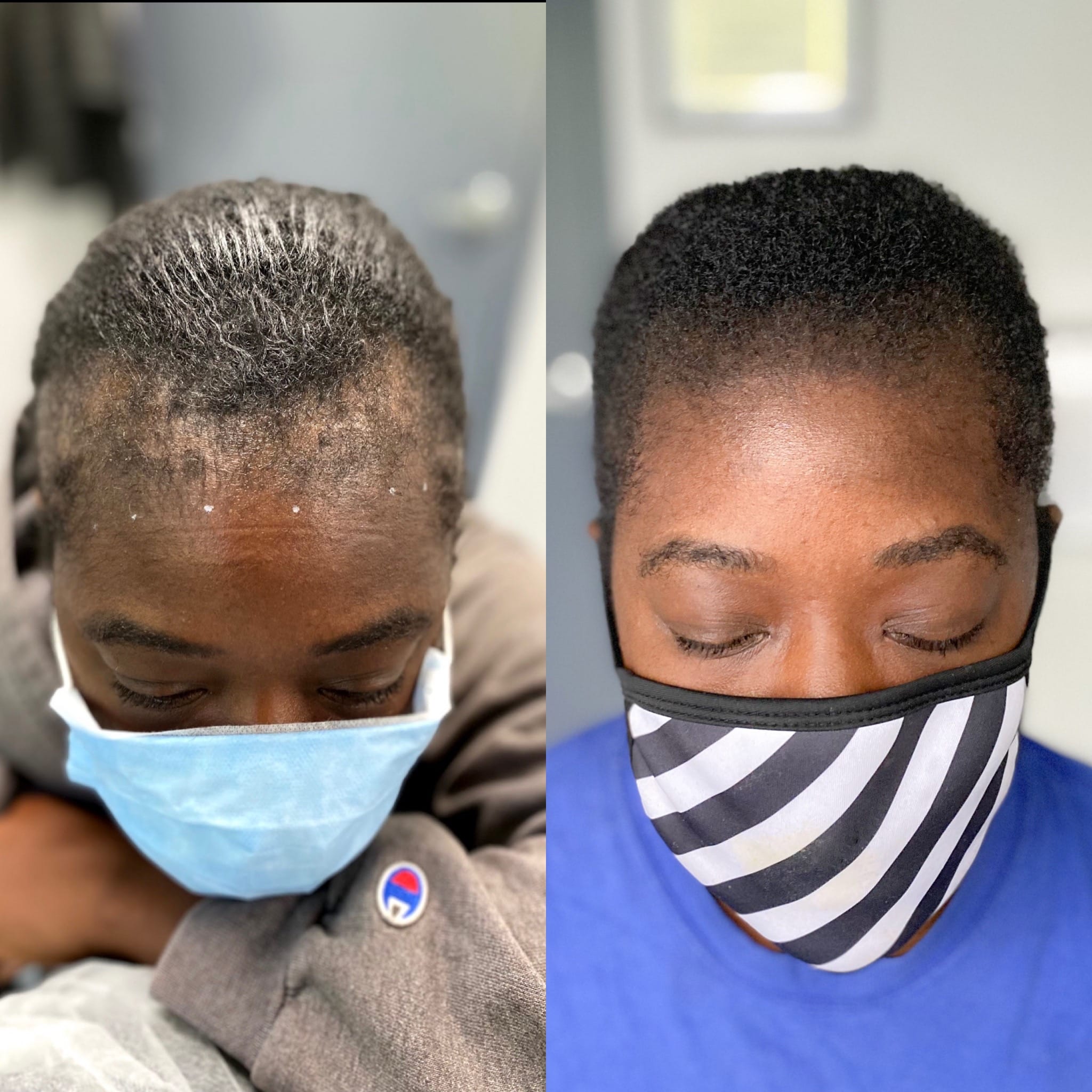 Before and fter photo of black /African American woman's traction alopecia scalp micropigmentation treatment