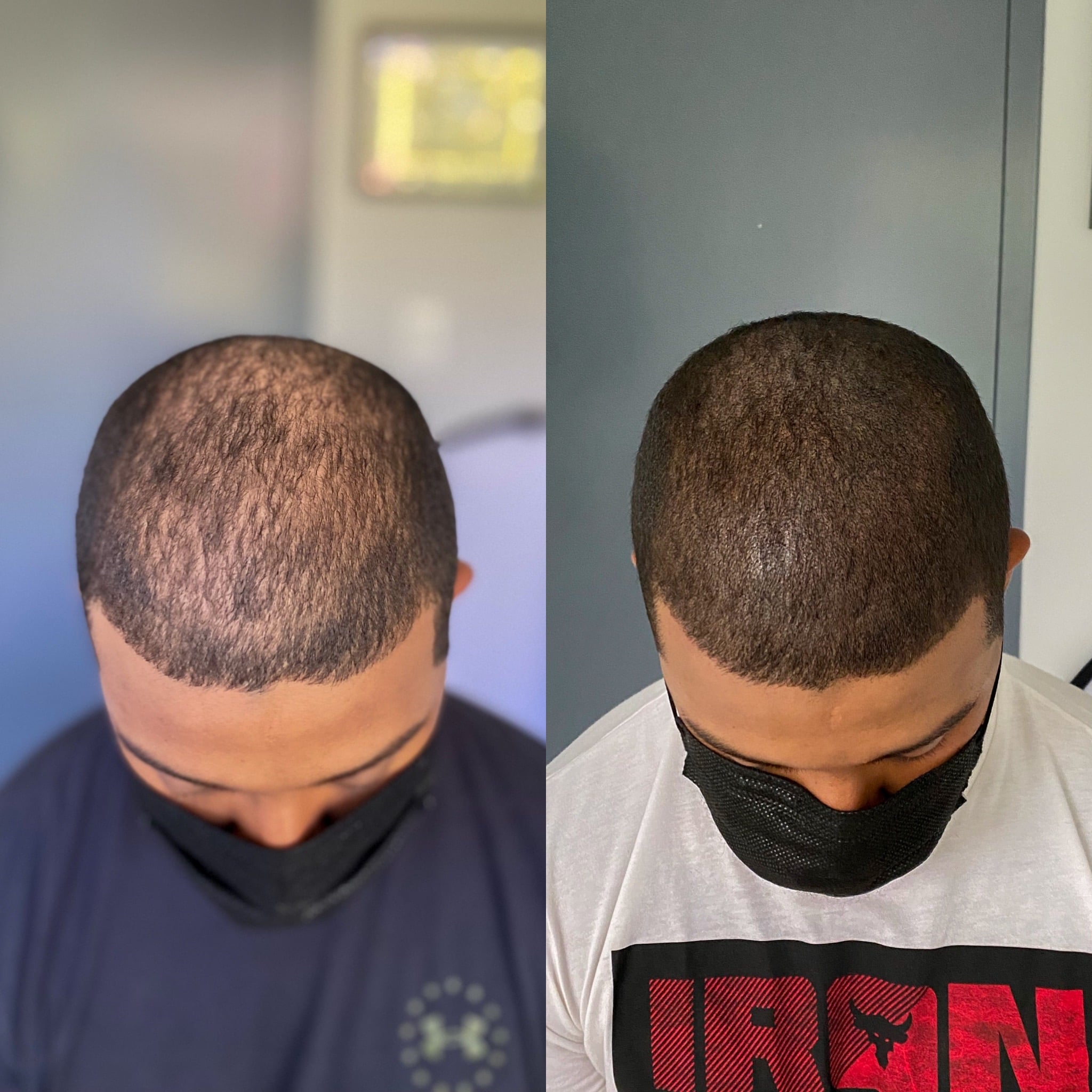 before and after density scalp micropigmentation for men