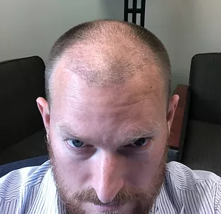 File000edited - Edge Scalp Ink