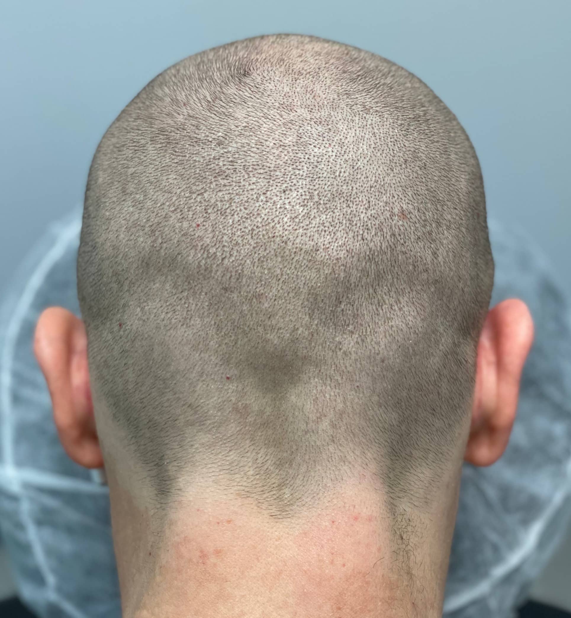 after photos of men's scalp micropigmentation scar camouflage