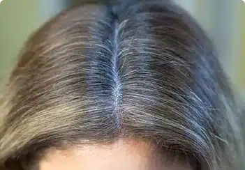 scalp micropigmentation woman example photo