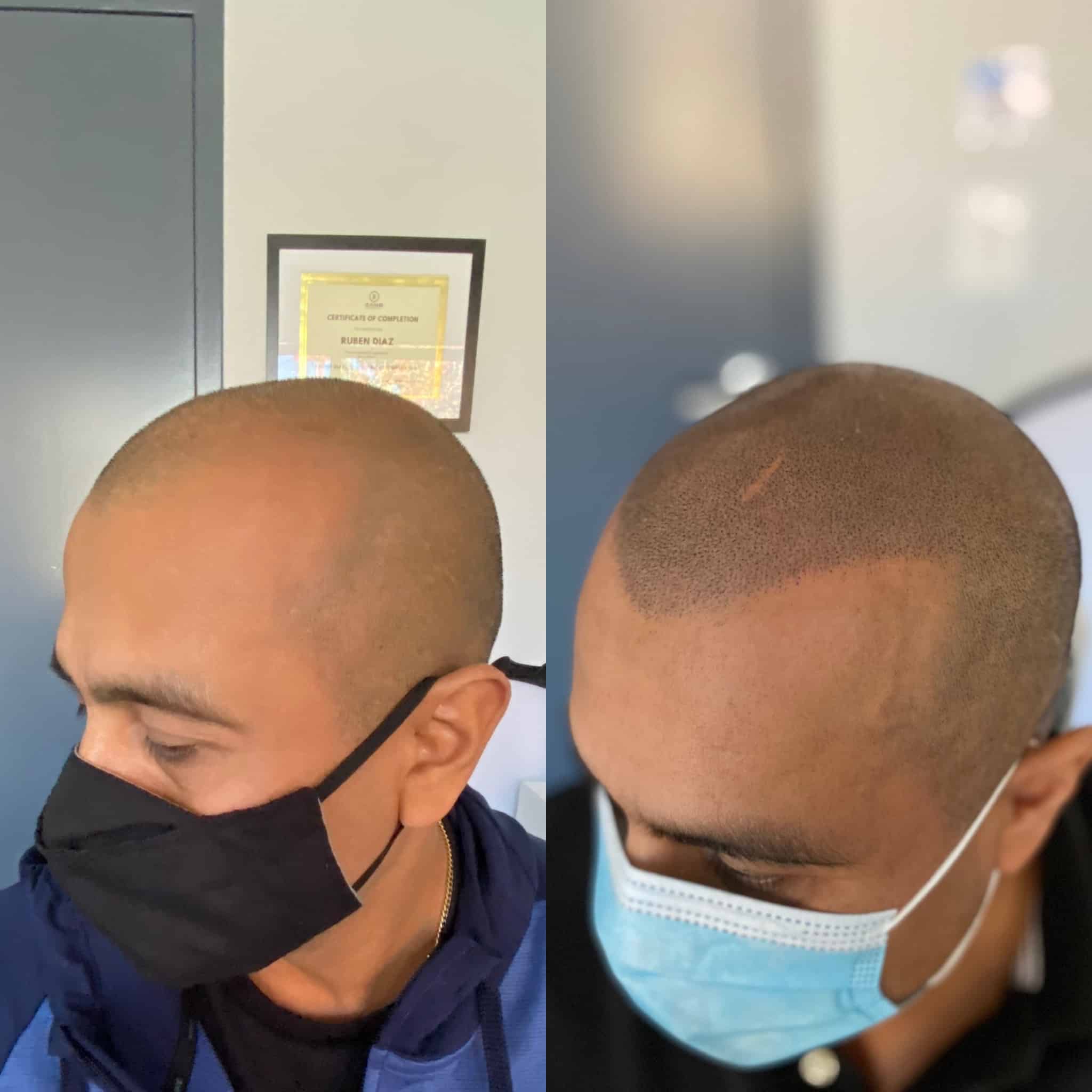 Scalp micropigmentation SMP before and after photo of scalp micropigmentation treatment