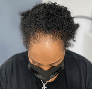 Women's Edges | Baby hairs | scalp micropigmentation | SMP | traction alopecia