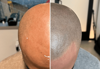 Before and after photo of man after scalp micropigmentation treatment