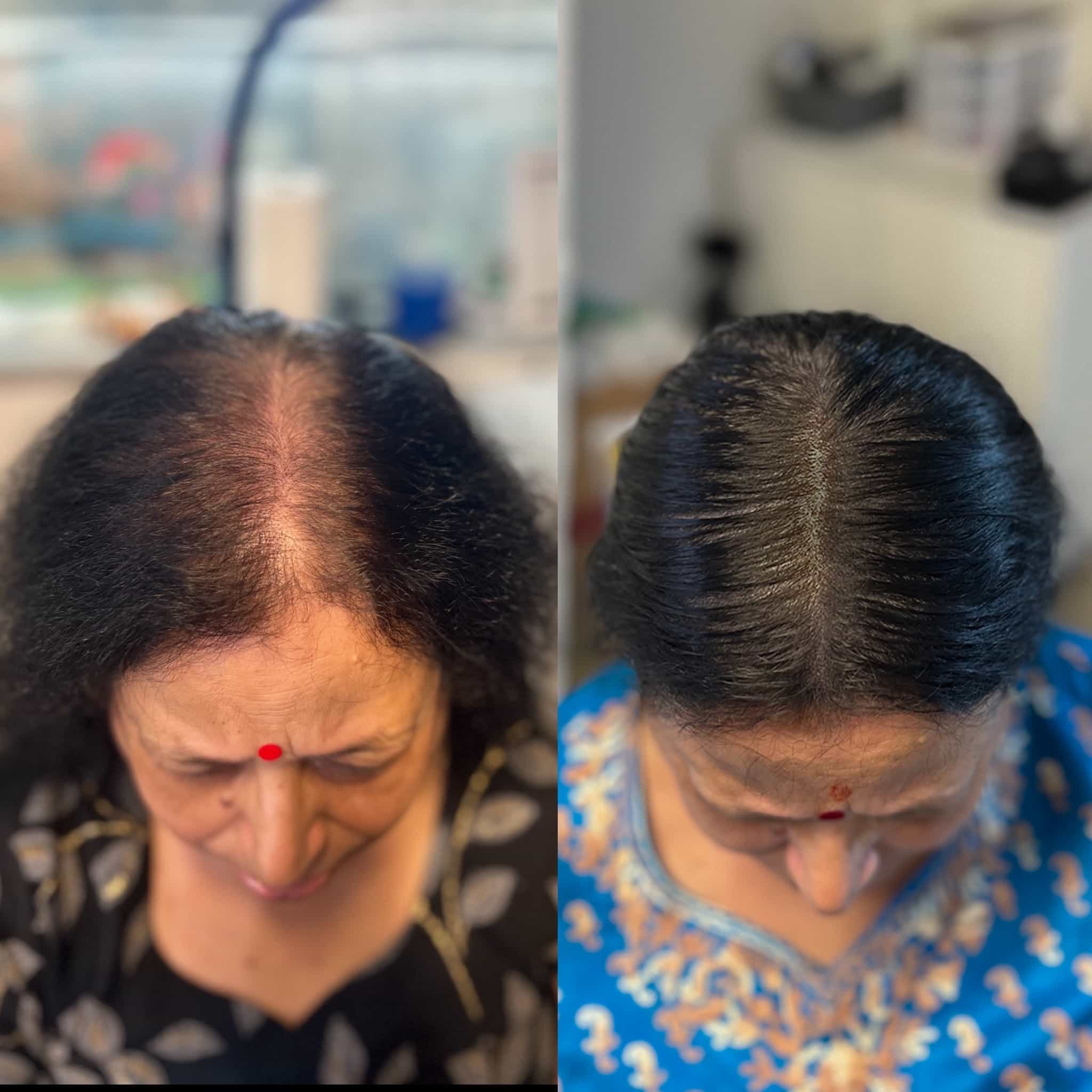 Client's before and after photos after hair tattoo/scalp micropigmentation