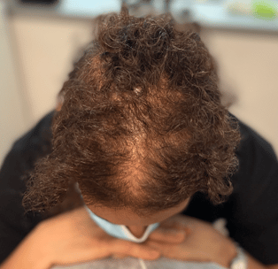 woman before scalp micropigmentation