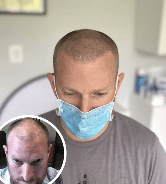 Caucasian male before and after his scalp micropigmentation treatment.