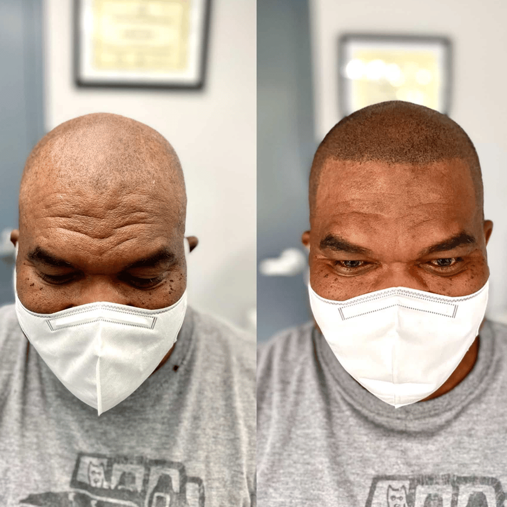 before and after black man scalp micropigmentation SMP