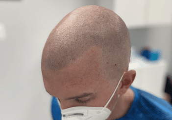 White caucasian male with scalp micropigmentation treatment process
