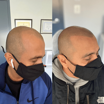 Before and after Hispanic/Latino man male pattern baldness