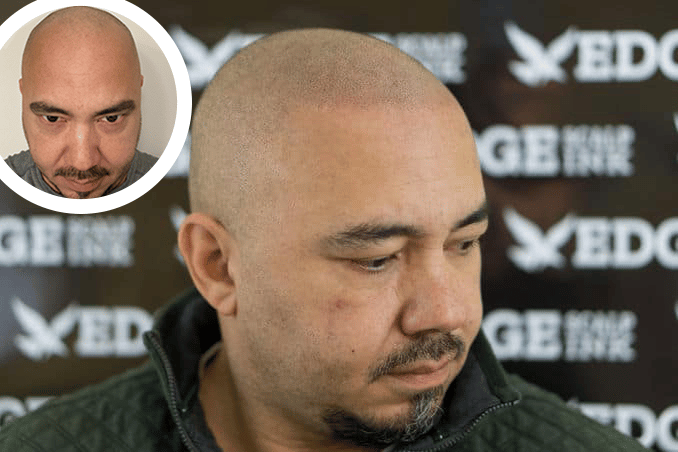 results of man before and after scalp micropigmentation