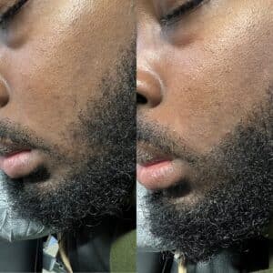 Black male before and after photos of scalp micropigmentation for beards.