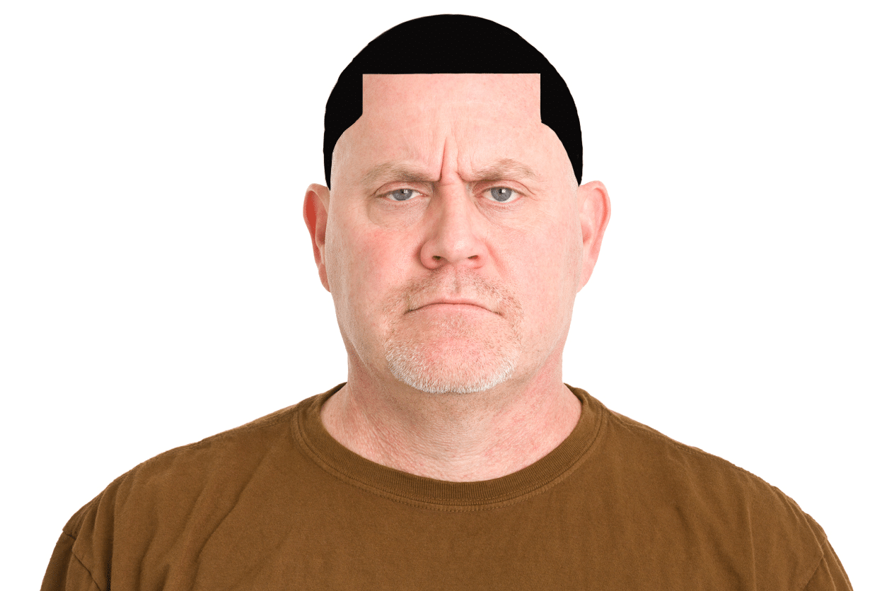 Image of white man with helmet head botched scalp micropigmentation