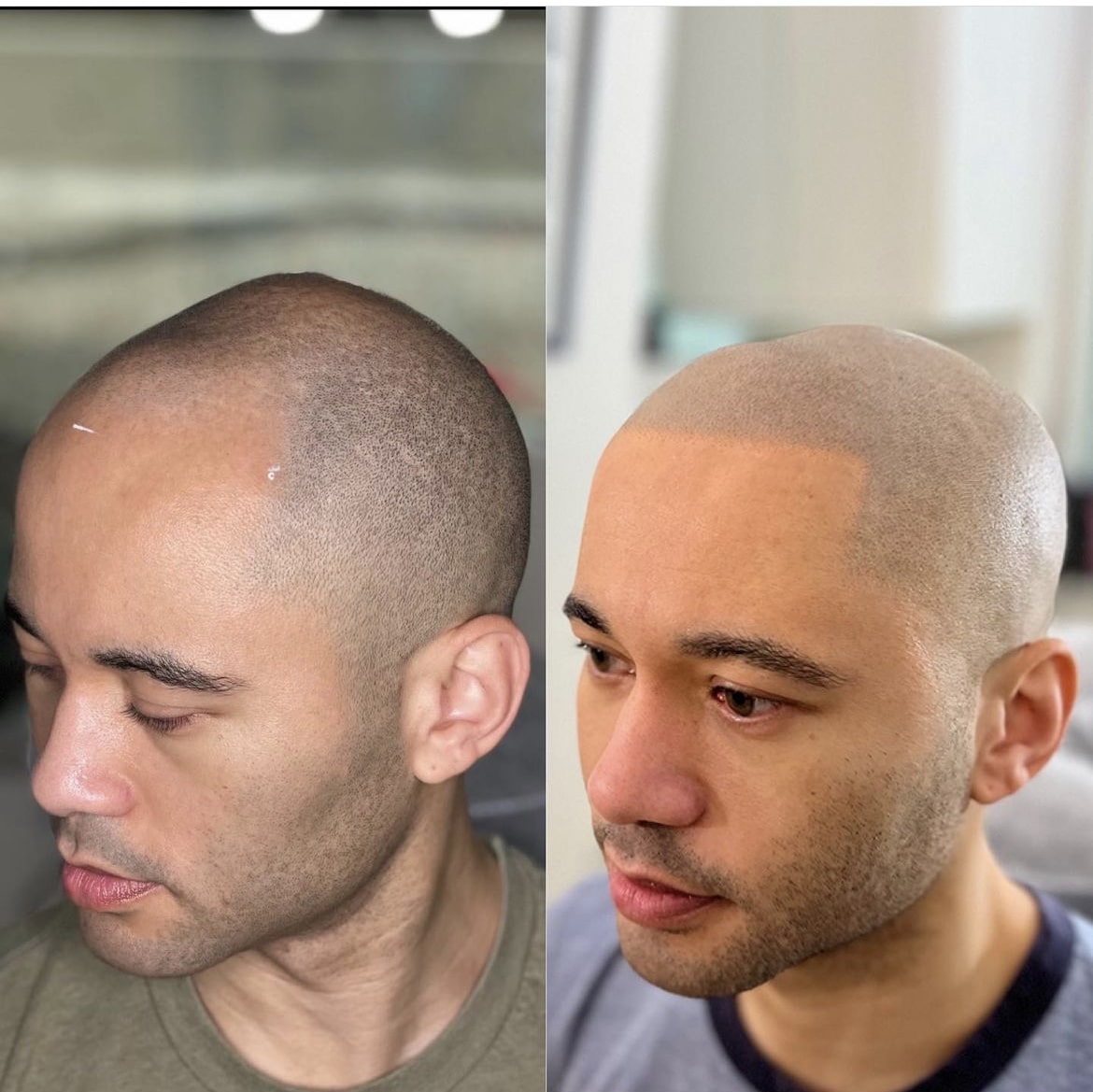 Man's scalp micropigmentation before and after photos