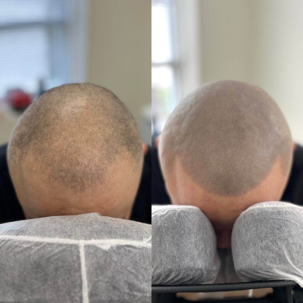 Before and after photo of Latino man who suffers from male pattern baldness