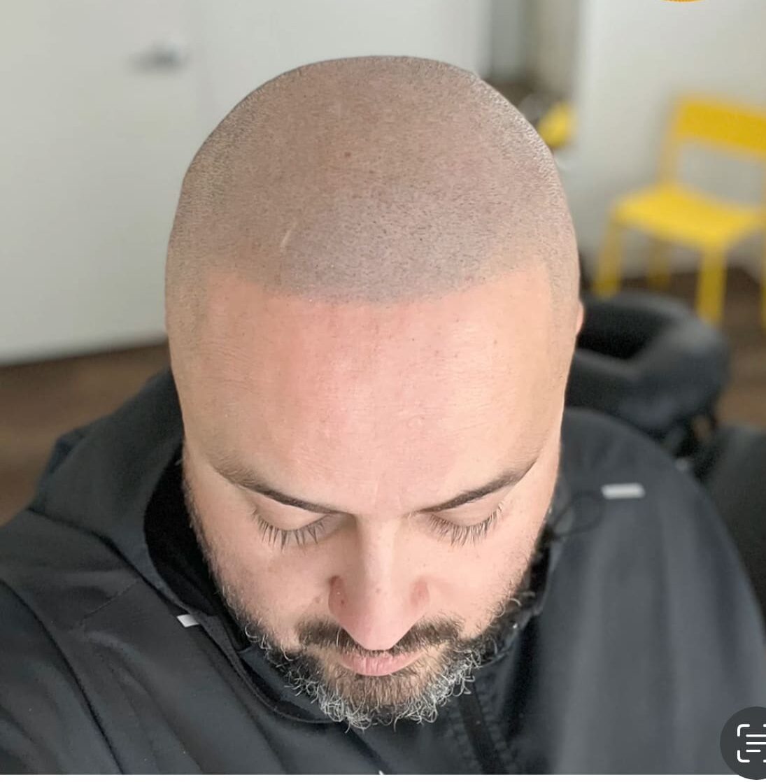 Photo of a man 5 years after his scalp micropigmentation treatment.