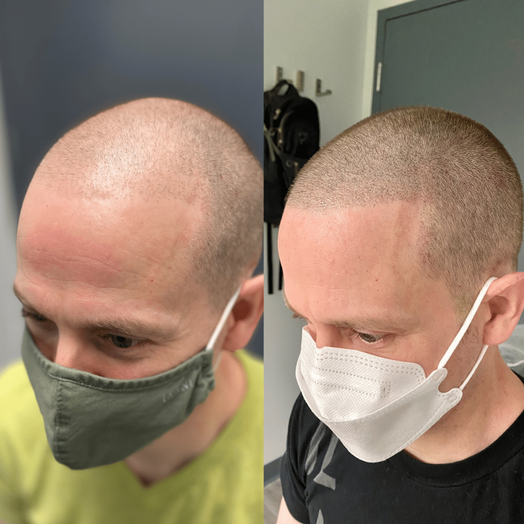 Before and after density scalp micropigmentation treatment for men.