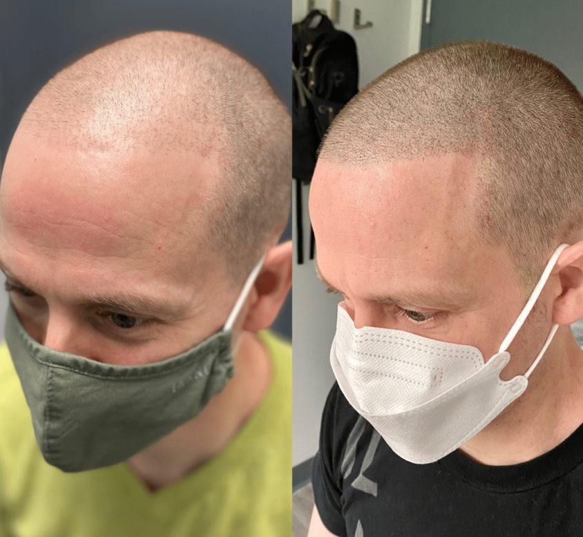 Before and after density scalp micropigmentation treatment for men.