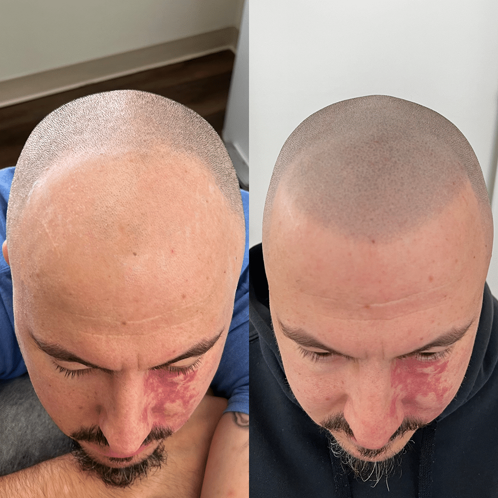 Before and after birdseye view of man who underwent scalp micropigmentation treatment