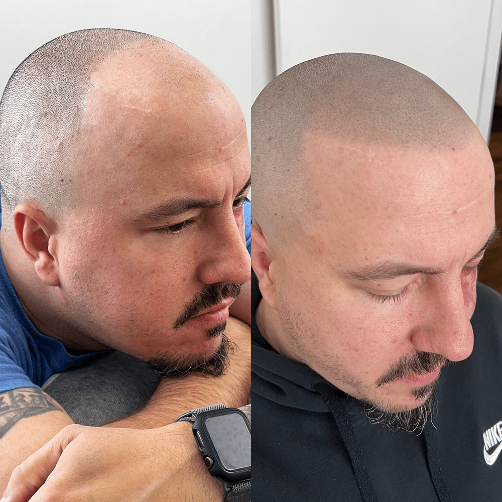 Before and after sideview of man who underwent scalp micropigmentation treatment