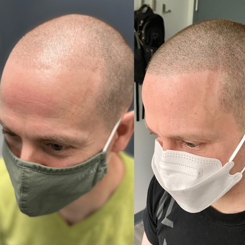 White male's before and after photo of scalp density micropigmentation treatment for men.