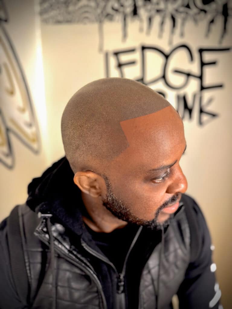 SMP vs. Hair Transplant: What You Should Know