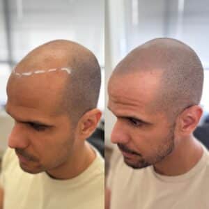 Before and After phot of men's scalp micropigmentation for density