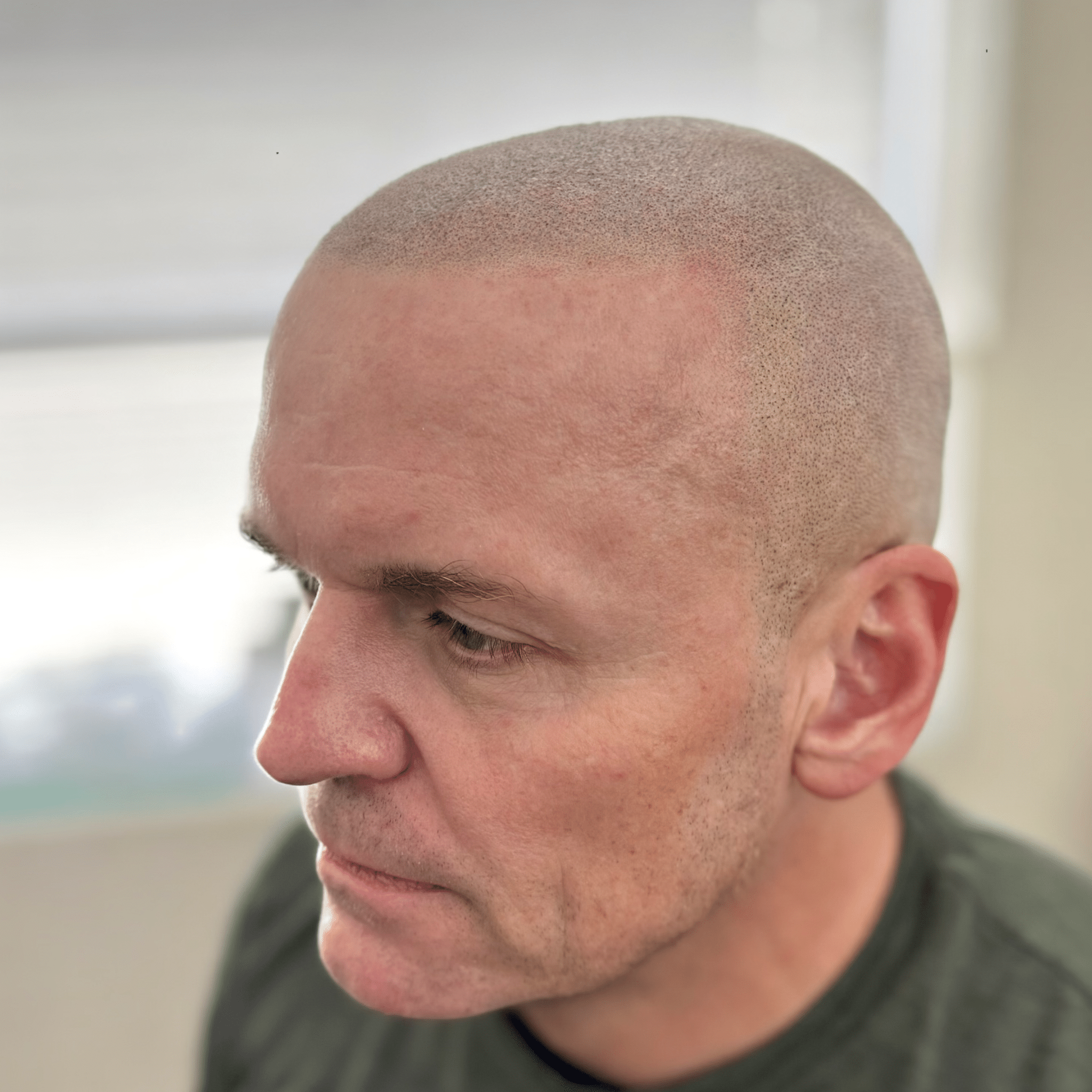 Home 11 Scalp micropigmentation results on a white male client.